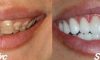 Giải pháp cho răng nhiễm Tétracycline, răng xỉn màu…