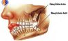 Nhổ răng khôn mọc ngầm an toàn tại nha khoa thẩm mỹ Hà Nội