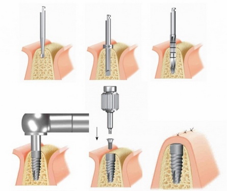 Quá trình cấy Implant nha khoa.